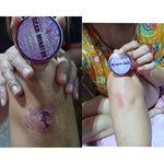 Scarminator Cream - Scar treatment